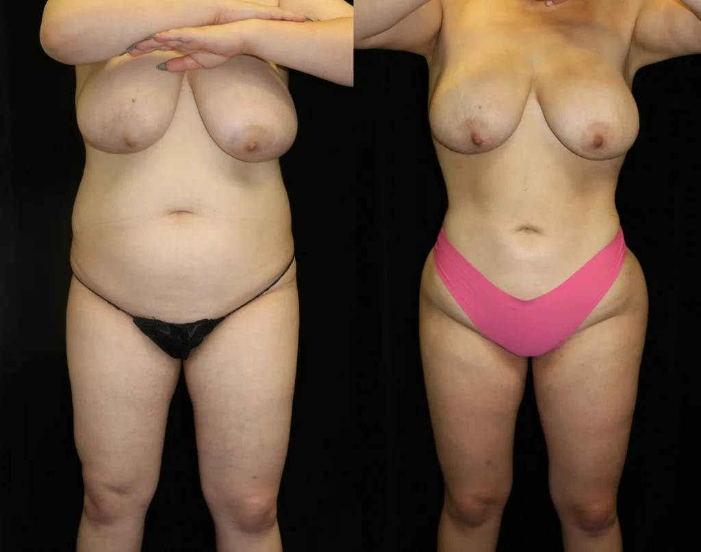 Front View Liposuction before and after photo by Dr. Tsai