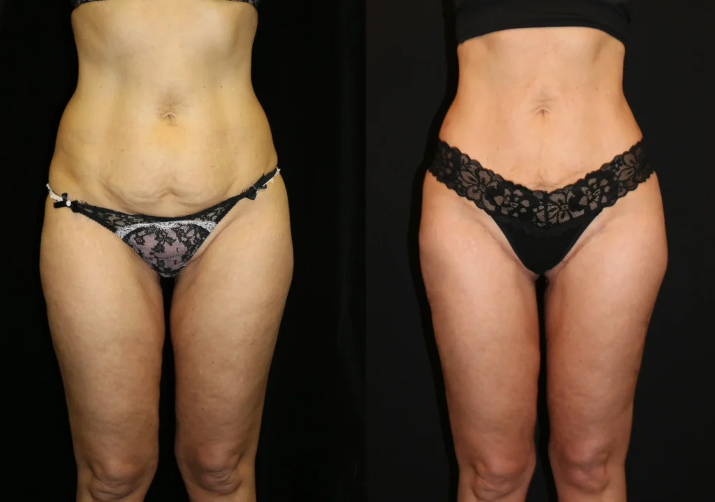 Front View Other Body Procedure before and after photo by Dr. Tsai
