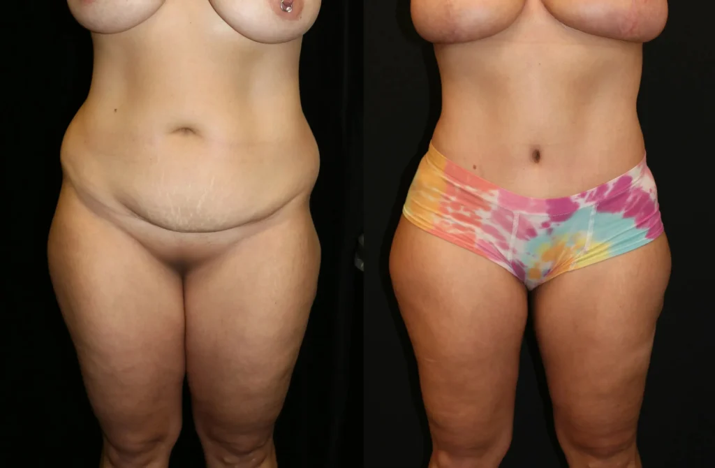 Front View Tummy Tuck before and after photo by Dr. Tsai