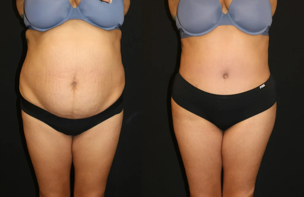 Front View Tummy Tuck before and after photo by Dr. Tsai