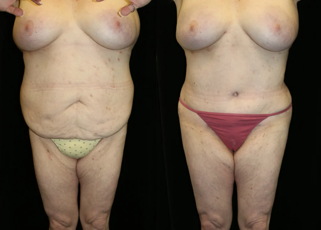Front View Tummy Tuck before and after photo by Dr. Tsai