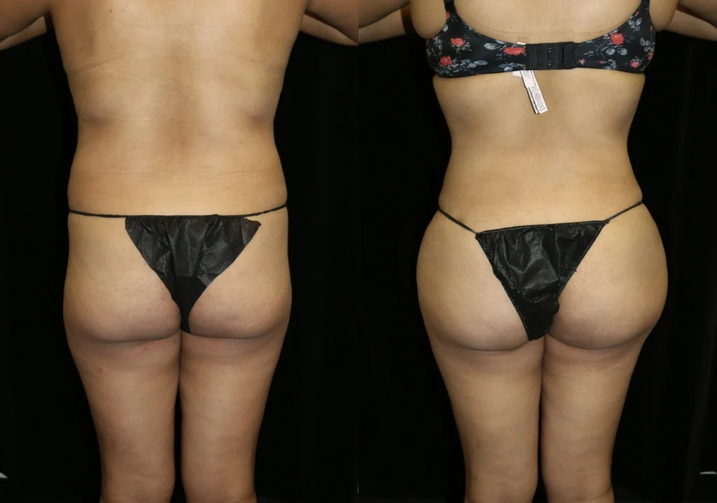 Back View Brazilian Butt Lift before and after photo by Dr. Tsai