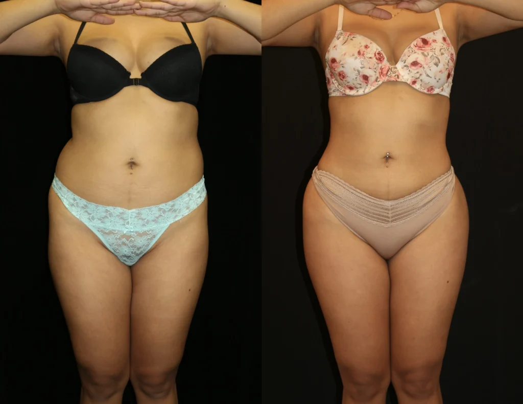 Front View Liposuction before and after photo by Dr. Tsai