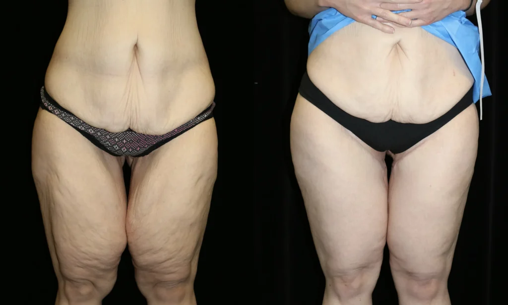 Front View Thigh Lift before and after photo by Dr. Tsai