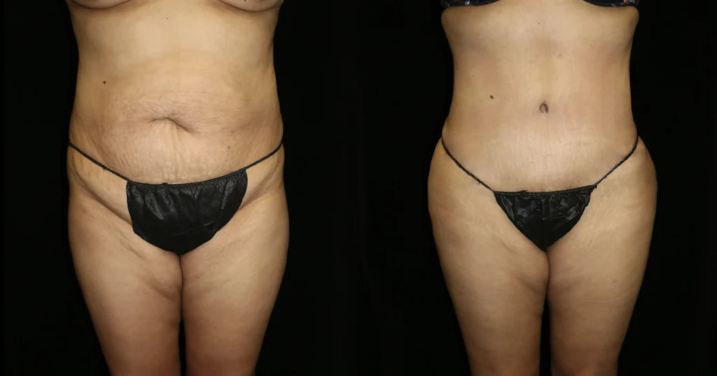 Front View Tummy Tuck before and after photo by Dr. Tsai